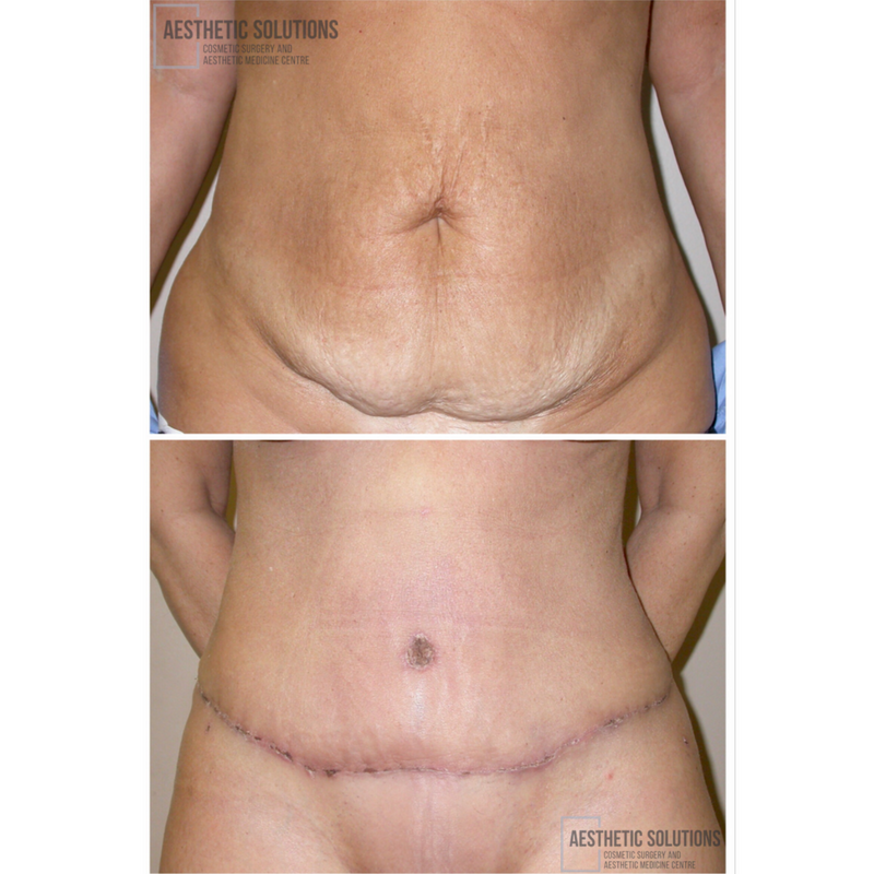 TT-png-before-after