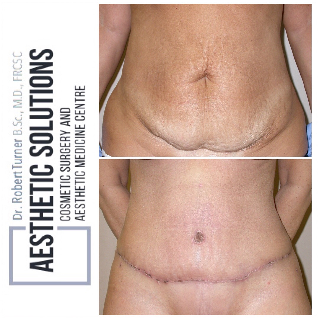 Tummy Tuck, Abdominoplasty